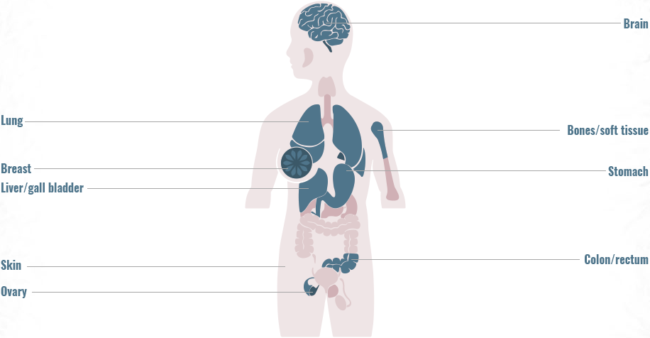 Distribution of ROS1 gene fusions across primary tumor sites graphic